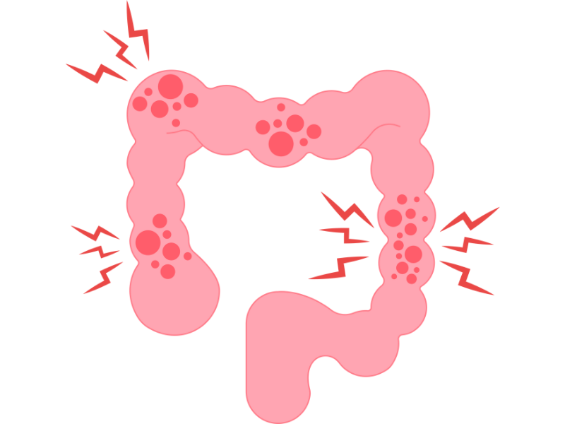 炎症性腸疾患